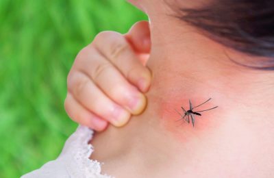 Trị vết muỗi đốt sưng đỏ như thế nào hiệu quả nhanh?