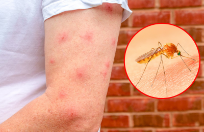 Nguy cơ nhiễm trùng từ vết muỗi đốt